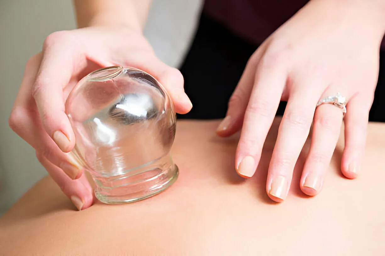 Glass cupping therapy applied to the back to relieve muscle tension and improve circulation at Legacy Aesthetic, Edmonton